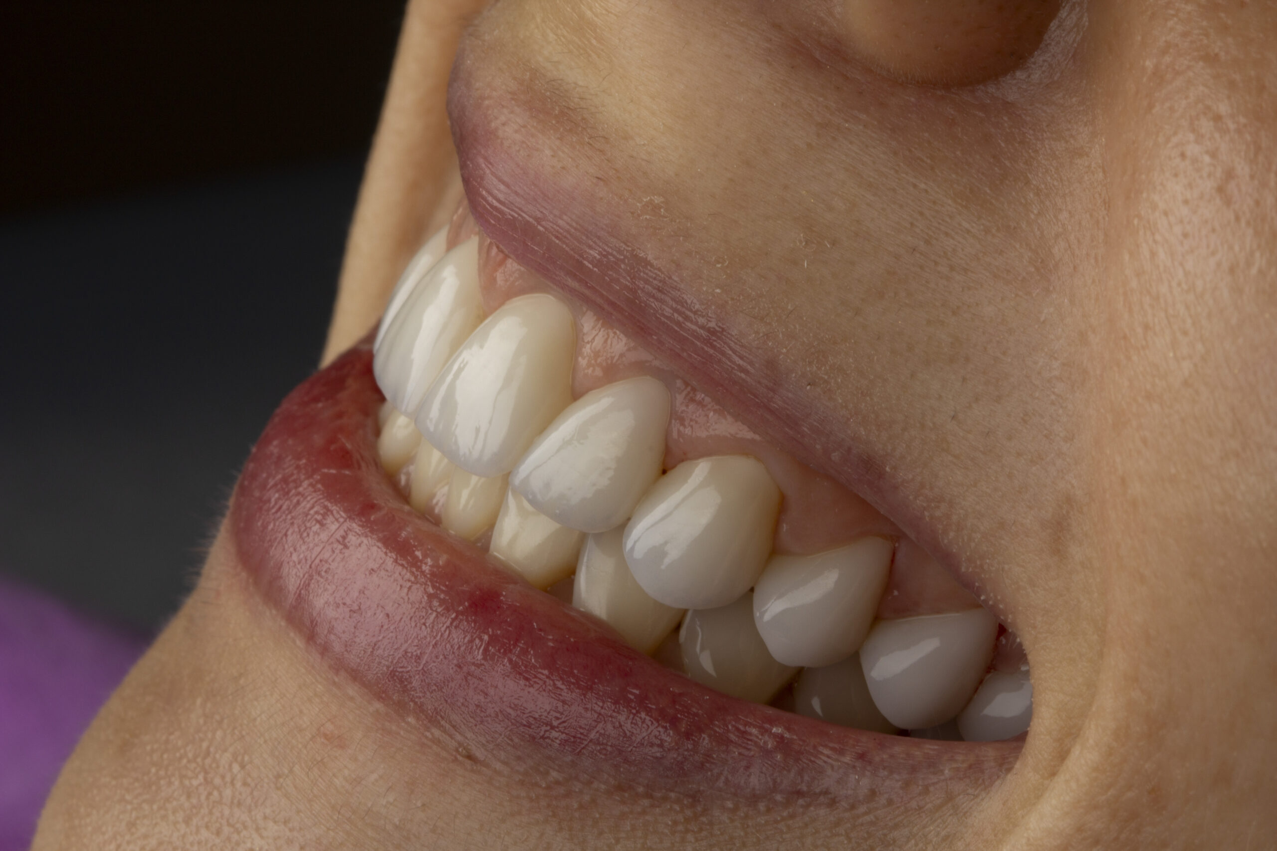  Tudo Sobre Lentes de Contato Dentais: Transforme Seu Sorriso com Naturalidade e Sofisticação