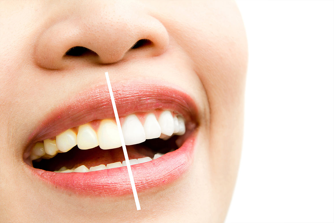  Clareamento Dental: Tudo o Que Você Precisa Saber Para um Sorriso Mais Branco e Saudável