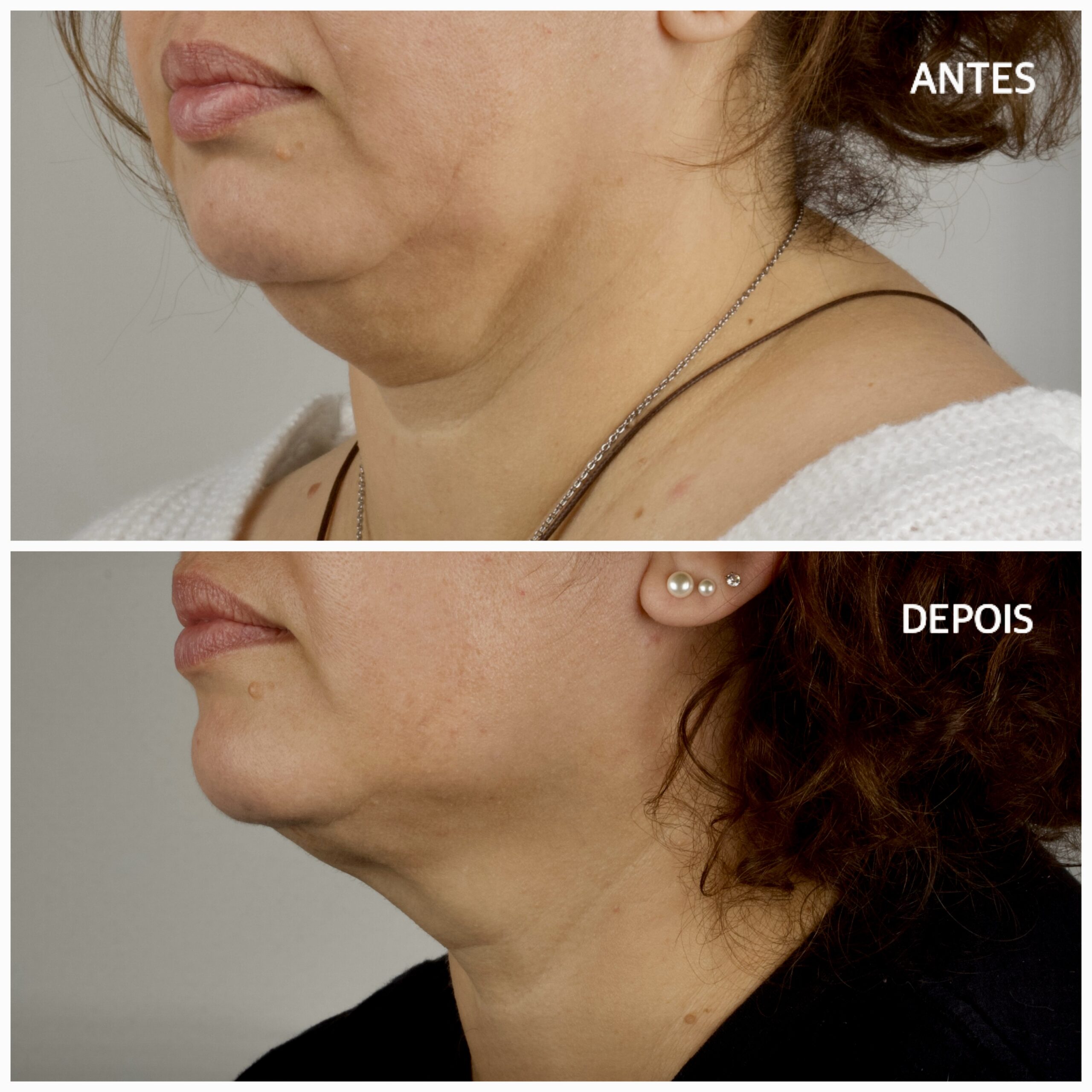 Dra. Débora Reis – Lipo de Papada Antes e depois de Lipo de Papada