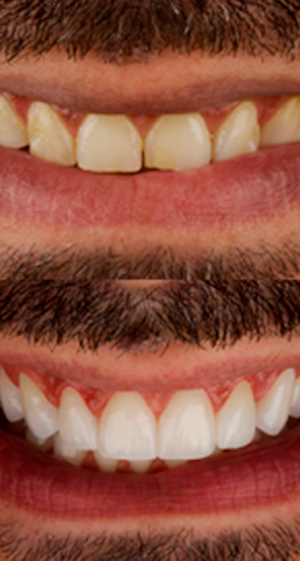 Lentes de Contato dental 1
