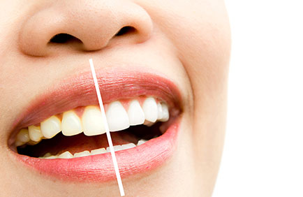 Dra Debora Reis – Clareamento Dental Comparação entre dentes amarelados e clareados após tratamento estético dental