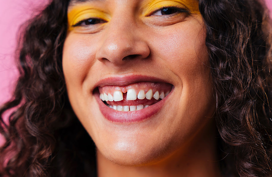 Mulher sorrindo com excesso de gengiva aparente, possível indicação para plástica gengival