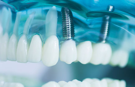 Dra Debora Reis – Implante Dentário Dra Debora Reis - Implante Dentário
