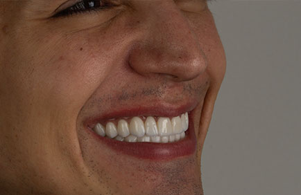 Dra Debora Reis – Lentes Dentais Homem sorrindo com dentes brancos e alinhados após aplicação de lentes de contato dental