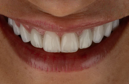 Dra Debora Reis – Lentes Dentais Lentes de contato dental proporcionando estética natural e proporções equilibradas ao sorriso