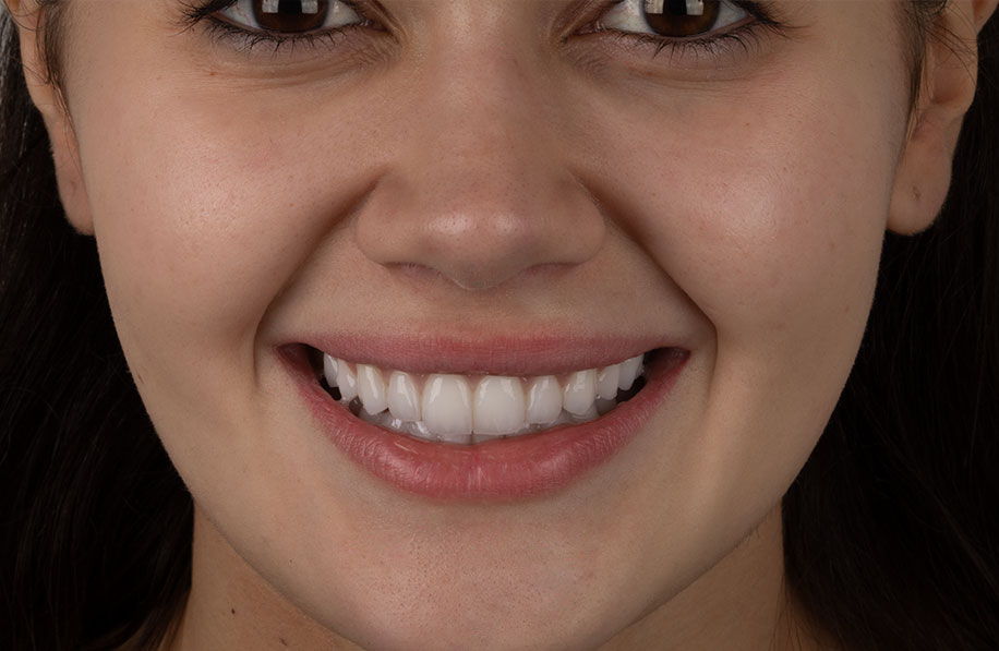 Sorriso com lentes de contato dental aplicadas, realçando harmonia e brilho natural dos dentes