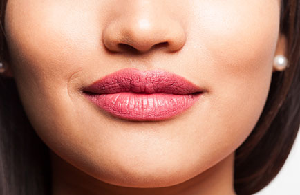 Resultado estético de lip lift com lábios definidos, simétricos e visualmente rejuvenescidos