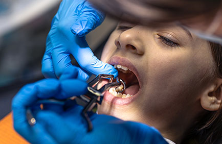 Extração de dente em paciente com auxílio de alavanca odontológica