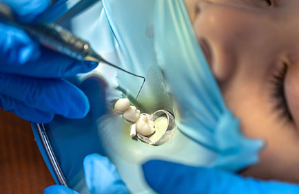 Dra Debora Reis – Endodontial | Tratamento de Canal Procedimento de canal em andamento com visualização detalhada dos dentes isolados e instrumentação canalicular