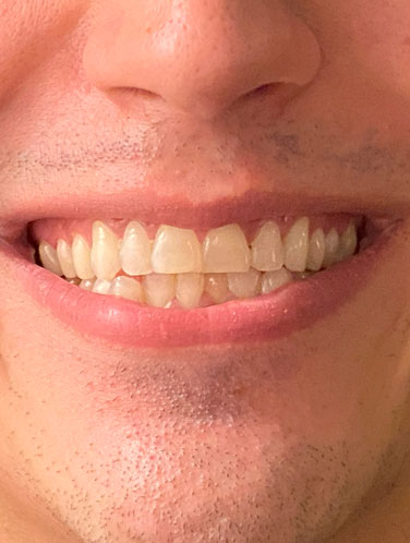 Caio Nascimento - Lentes de contato dental