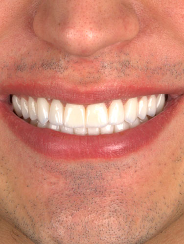 Caio Nascimento - Lentes de contato dental