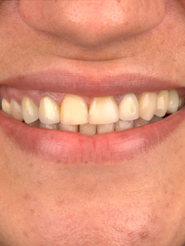 Daniele Freire - Lentes de contato dental
