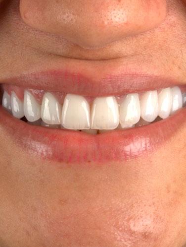Daniele Freire - Lentes de contato dental