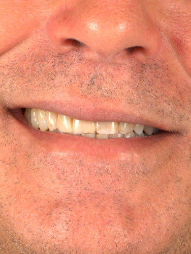 Flávio Rodrigues - Lentes de contato dental