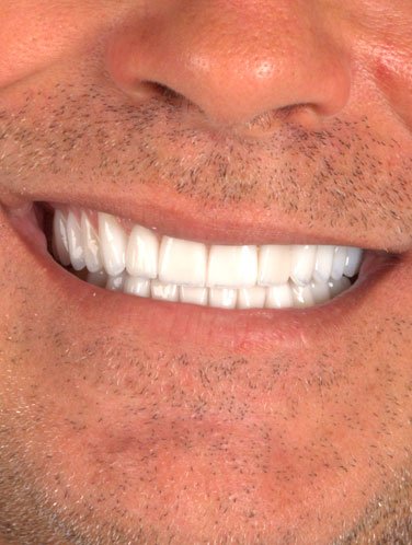 Flávio Rodrigues - Lentes de contato dental