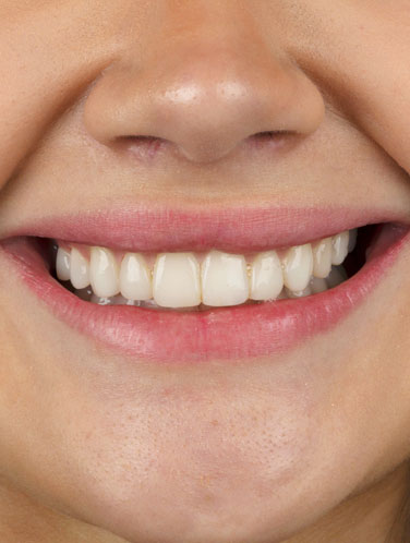 Franciny Ehlke - Lentes de contato dental