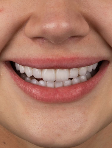 Franciny Ehlke - Lentes de contato dental