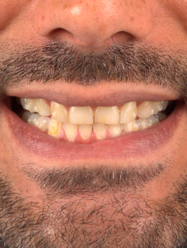 Lucas Ebram - Lentes de contato dental