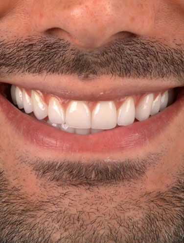 Lucas Ebram - Lentes de contato dental