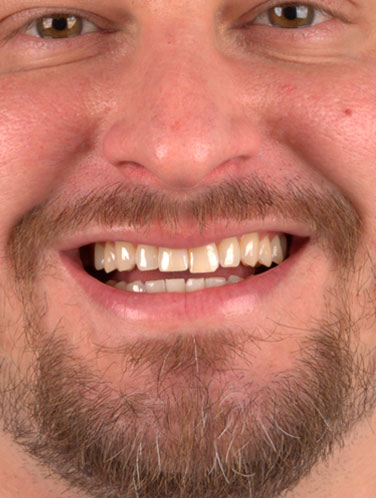 Lucas Freitas - Antes e Depois - Lente de Contato Dental