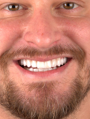 Lucas Freitas - Antes e Depois - Lente de Contato Dental