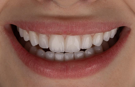 Franciny Ehlke - Lentes de contato dental