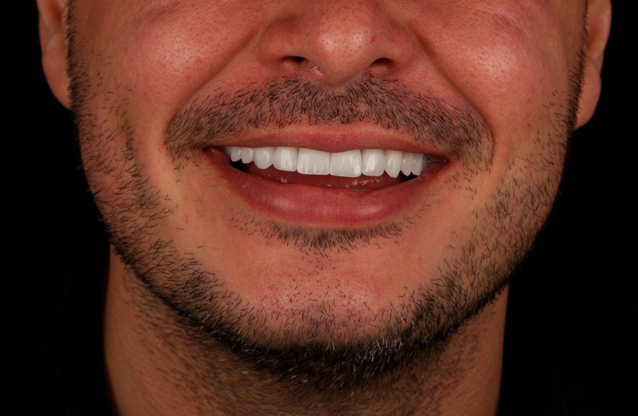 Lentes de contato dental - Day Clinic