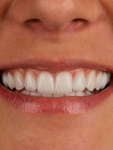 Gabriela Garcia Marconi sorri com suas novas lentes de contato dental, feitas especialmente pela Dra. Débora Reis